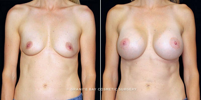 Case # 148 after photo