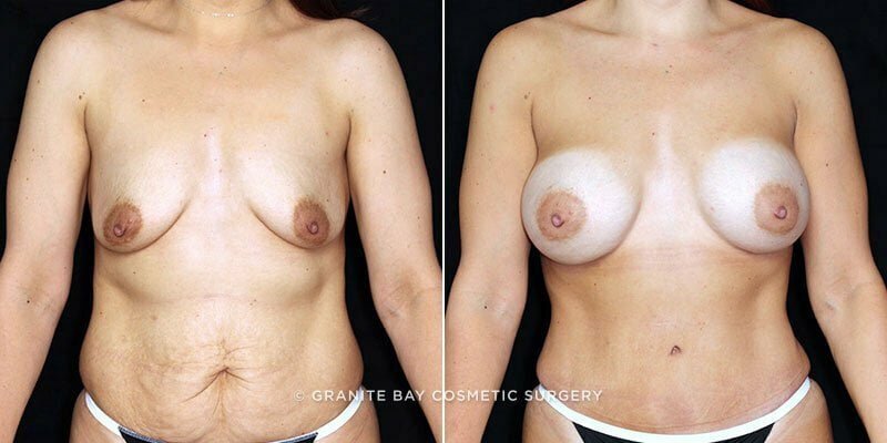 Case # 151 after photo