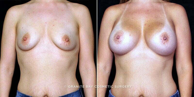 Case # 152 after photo