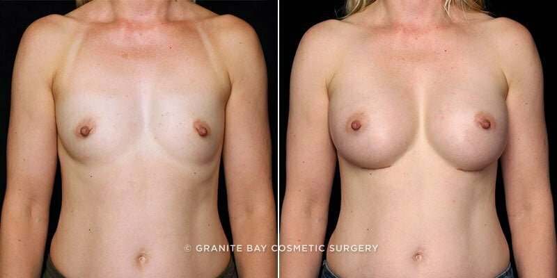 Case # 166 after photo