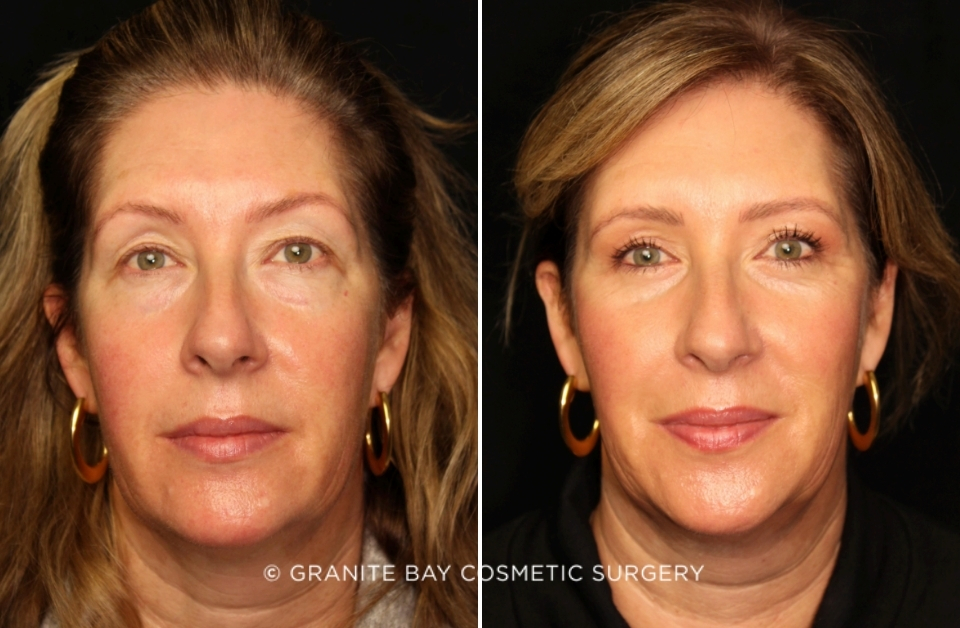 Case # 15 before photo